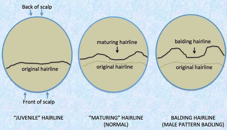 IS YOUR HAIRLINE 'MATURING' OR A 'BALDING'